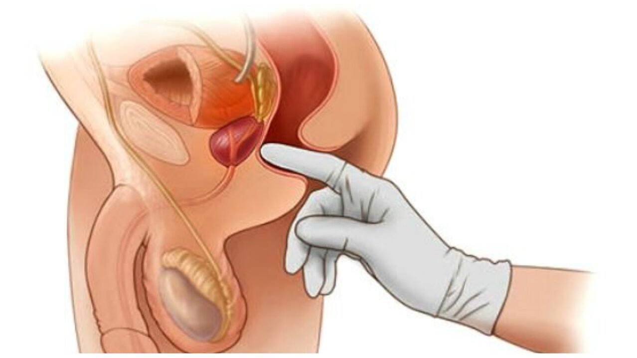 masáž prostaty pro chronickou prostatitidu