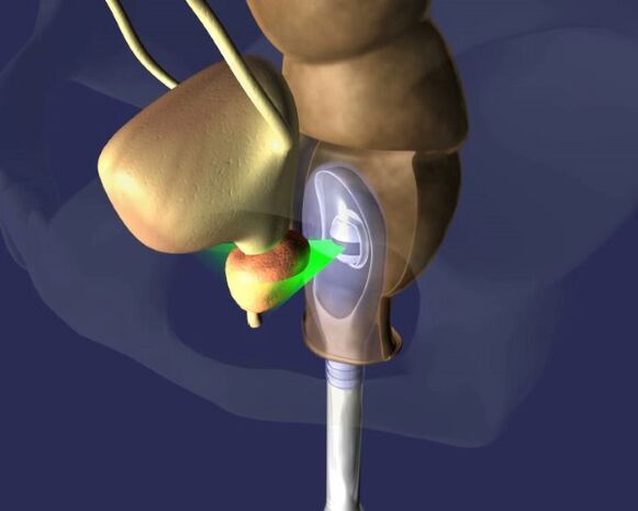 dopad ultrazvuku na prostatu s prostatitidou
