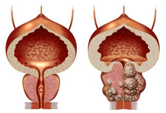 zdravá prostata a adenom prostaty