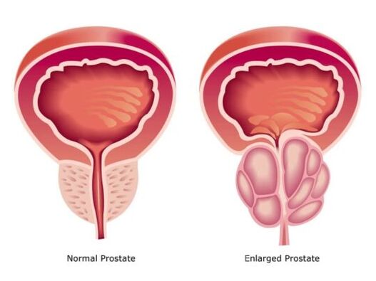 Normální a zvětšená prostata