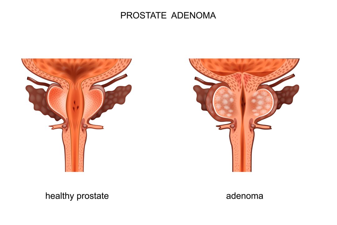 zdravá prostata as adenomem